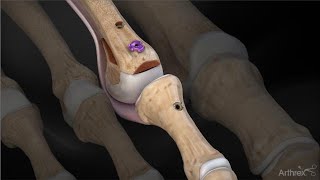 Increasing Big Toe Mobility  Self Mobilization  Ask Dr Abelson [upl. by Birecree]