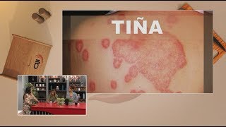 Dermatología Tiña corporis Hongos en la piel [upl. by Mel]