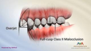 Malocclusion  Class II Div I [upl. by Buckels]