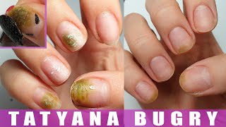 How I Cured My Nails  Shocking Experience  Restoring Nails from Bacteria [upl. by Mufinella716]