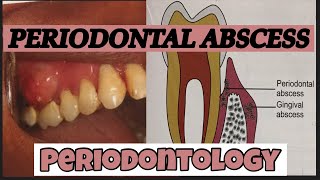 PERIODONTAL ABSCESS II PERIODONTOLOGY [upl. by Yblehs]