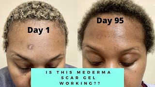 IS THIS MEDERMA WORKING  MEDERMA ADVANCED SCAR GEL 3 MONTH UPDATE  NIJAH J [upl. by Sert]