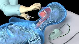 Nasotracheal suctioning NTS  3D animation [upl. by Nauh]