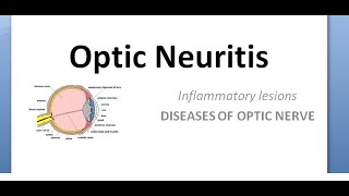 Ophthalmology Optic neuritis Papillitis NeuroRetinitis RetroBulbar phosphenes uhthoff pulfrich [upl. by Brunell]