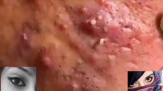 Severe Cystic Acne Infection Treatment Young Age [upl. by Elokyn]