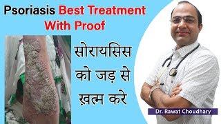 सोरायसिस का पूरा इलाज  Psoriasis Best Homeopathic Treatment  Best Homeopathic Doctor in India [upl. by Danyette]