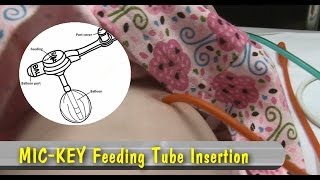 MIC KEY Gastrostomy Feeding Tube [upl. by Servetnick496]