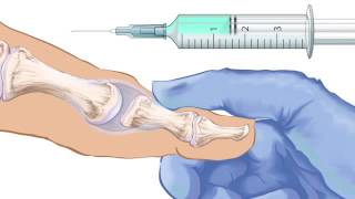 1st MTPJ arthrodesis procedure [upl. by Codd]