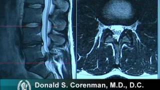 Lumbar Disc Replacement Surgery Explained By a Spine Surgeon [upl. by Schonfield]