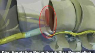 Step by step how to perform a lumbar laminectomy [upl. by Rozek455]