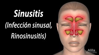 Sinusitis Animación Alila Medical Media Español [upl. by Lorou826]