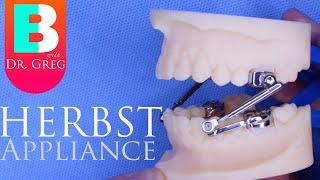 BRACES EXPLAINED Herbst Appliance [upl. by Yttig]