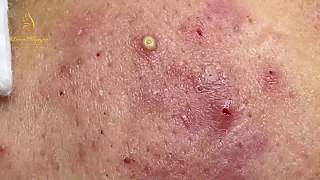 Treatment of pustules and inflammatory acne 84  Loan Nguyen [upl. by Rebliw]