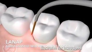 How Does Laser Surgery Work Treat Gum Disease  LANAP [upl. by Oaht99]