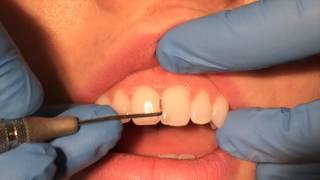 Periodontal Probing [upl. by Zenda]