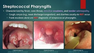 Streptococcal Pharyngitis [upl. by Meggie]