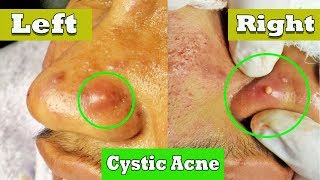 Drainage de lacné kystique sur le nez  cystic acne extraction [upl. by Inaj]