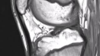 OsgoodSchlatter Disease [upl. by Hutner]