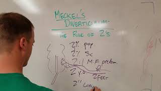 Meckels Diverticulum The Rule of 2s [upl. by Jabin]