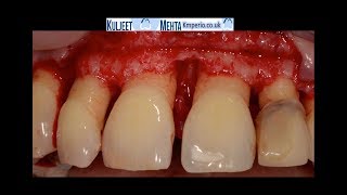 Periodontal Surgery Upper Front Teeth [upl. by Areivax]