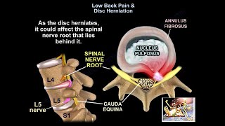 Cervical Disc Replacement [upl. by Kacey]