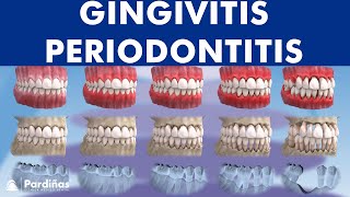 Gingivitis and Periodontitis  Evolution © [upl. by Kryska]