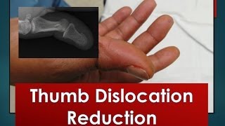 Thumb Dislocation Reduction [upl. by Dlaner]