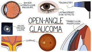 Understanding Open Angle Glaucoma [upl. by Daggett]