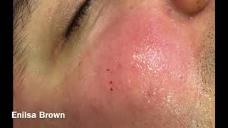 Christians Acne Treatment  Blackheads Extractions [upl. by Nalon]