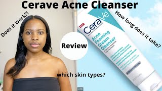 Watch This Before You Buy Cerave Acne Foaming Cream Cleanser Review⎜On Oily Acne prone Skin [upl. by Kciredohr249]