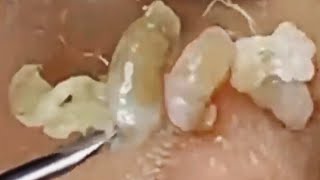 Deep blackhead extraction Cystic acne amp pimple popping 10 [upl. by Enaxor]