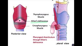 ESOPHAGEAL DIVERTICULUM [upl. by Aenet]