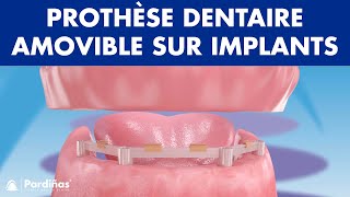 Prothèse dentaire amovible sur implants © [upl. by Homovec]