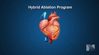 Atrial Fibrillation Treatment Hybrid Atrial Fibrillation AF Ablation [upl. by Ahsenik632]