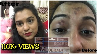 mederma cream review how to remove acne scar and stretch mark naturally live demo with mederma [upl. by Noli188]