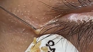 Deep blackhead extraction Cystic acne amp pimple popping 95 [upl. by Vaden]