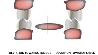 Introduction to equilibration Occlusal interferences [upl. by Ahsiem572]