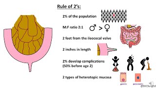 Meckel’s Diverticulum [upl. by Yvad]