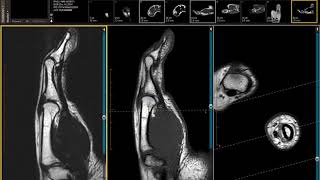 Talus Fractures  Everything You Need To Know  Dr Nabil Ebraheim [upl. by Artair773]