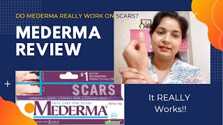 Mederma Cream Review for AcneBurn Scars and Stretch Marks [upl. by Nyleimaj]