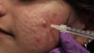 Watch amp Learn Intralesional injections [upl. by Reni805]