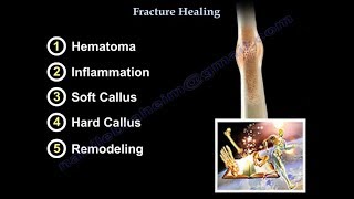 Calcaneal Fracture Classifications  Everything You Need To Know  Dr Nabil Ebraheim [upl. by Namsaj]