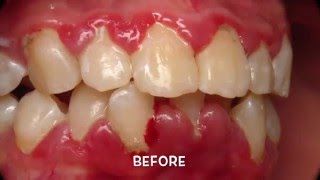 Treatment of Periodontal Gum Disease [upl. by Anivram]