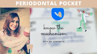 periodontal pocket carranza [upl. by Yelmene]