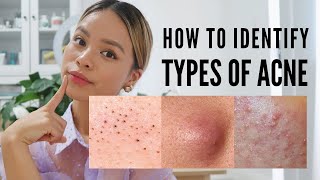 How to treat EVERY type of acne With Pictures [upl. by Darcy]