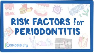 Risk Factors for Periodontitis [upl. by Eneres399]