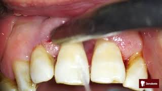 Advanced periodontal disease [upl. by Lienaj926]