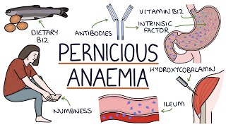 Understanding Pernicious Anaemia B12 Deficiency [upl. by Alrad]