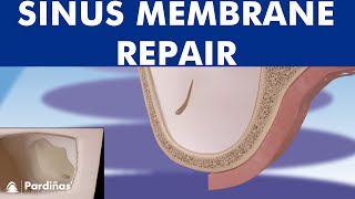 Sinus membrane perforation repair © [upl. by Salbu]