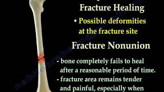 Fracture Healing Part 1  Everything You Need To Know  Dr Nabil Ebraheim [upl. by Ainorev]